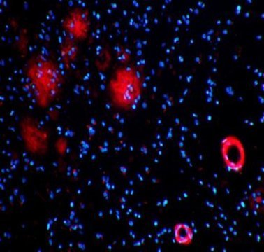 Hersenweefsel van Alzheimerpati